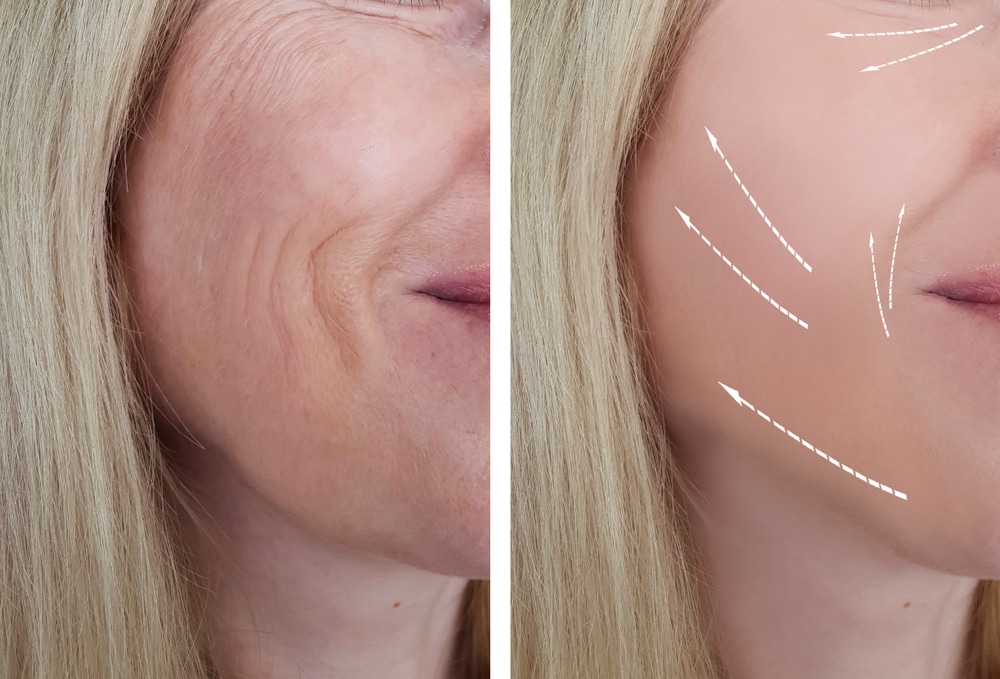 Cheek Lift