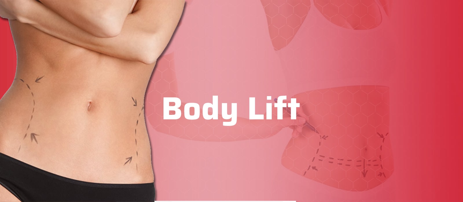 Body Lift