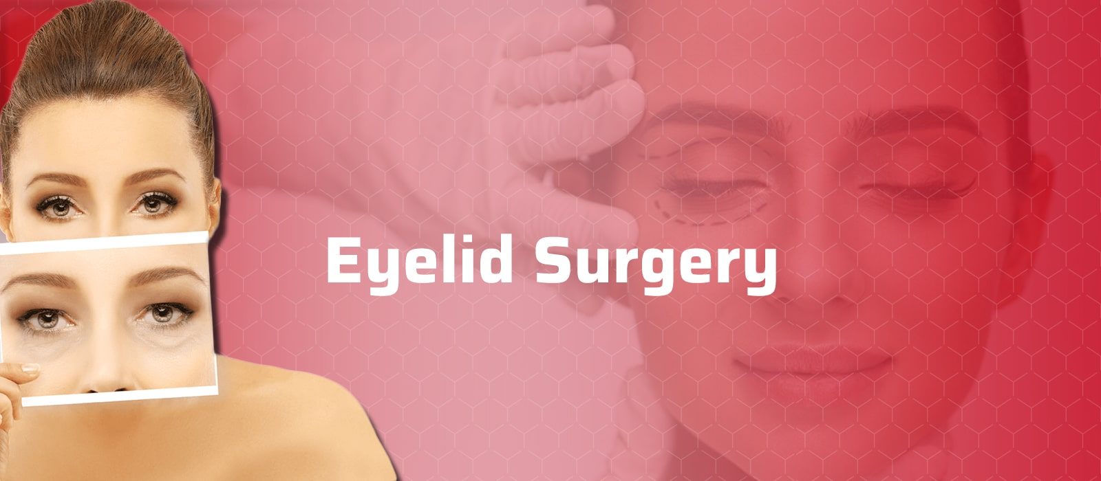 Eyelid Surgery (Blepharoplasty)