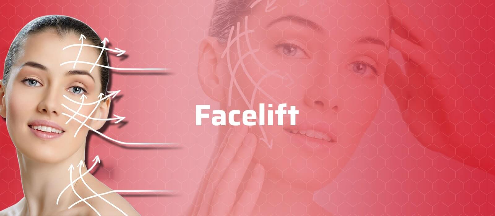 Facelift