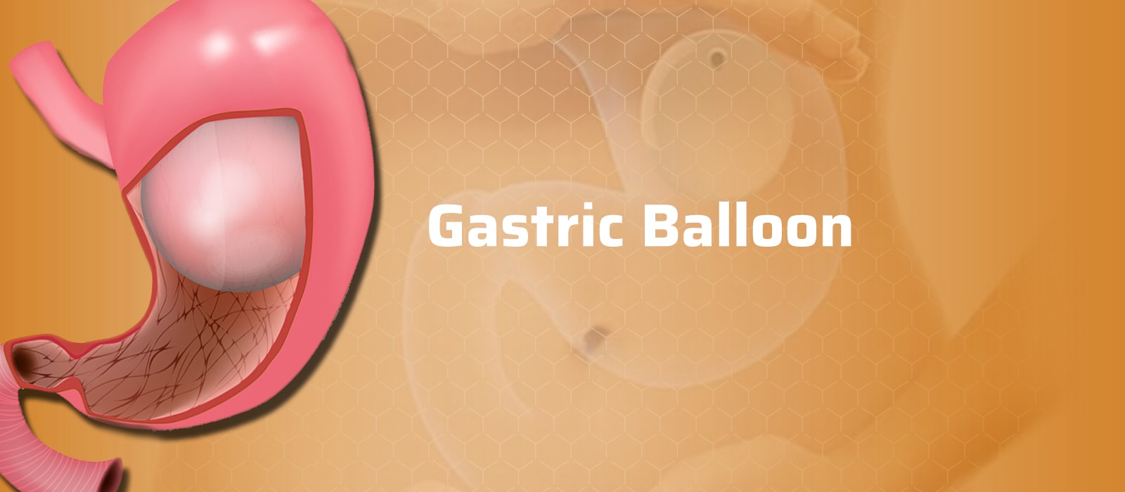 Gastric Balloon