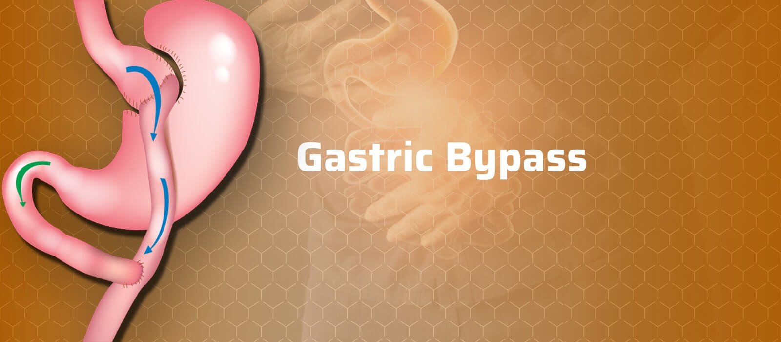 Gastric Bypass