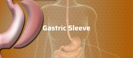 Gastric Sleeve