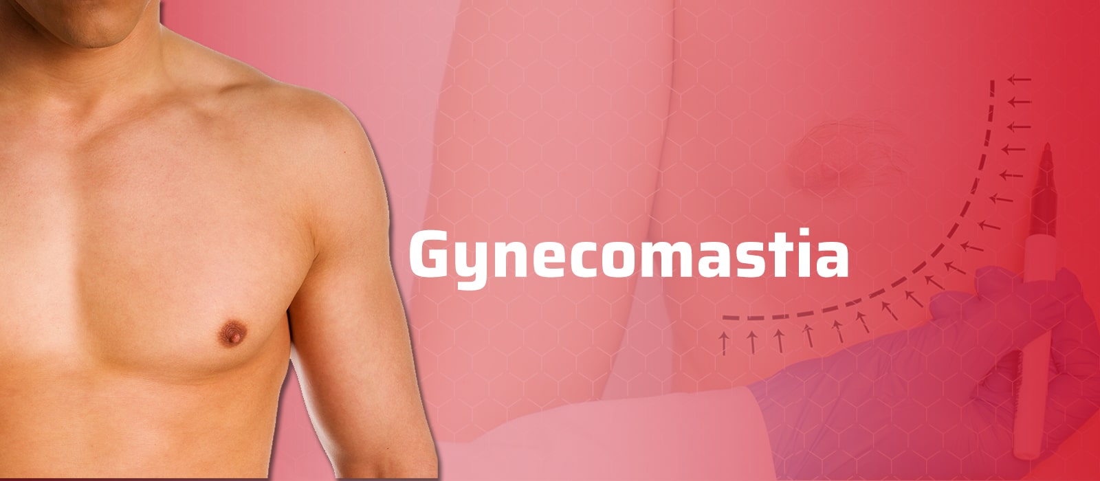 Gynecomastia