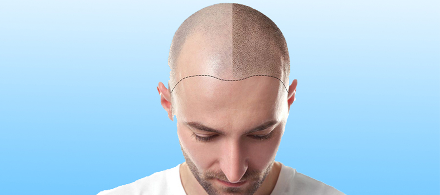 DHI Pro Hair Transplant